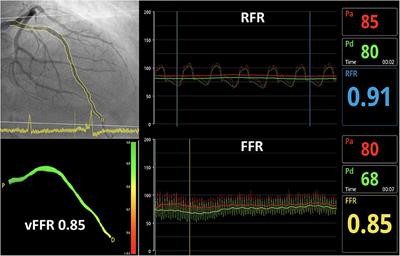 Agreement Between Invasive Wire-Based and Angiography-Based Vessel Fractional Flow Reserve Assessment on Intermediate Coronary Stenoses